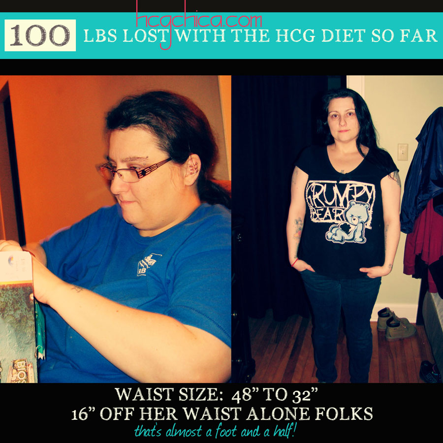 hCG Diet - Before and After - 100 lbs Loss